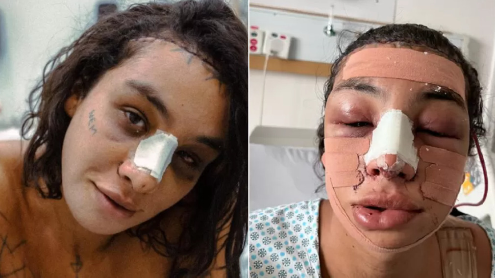 Linn da Quebrada passa por cirurgia de afirmação de gênero