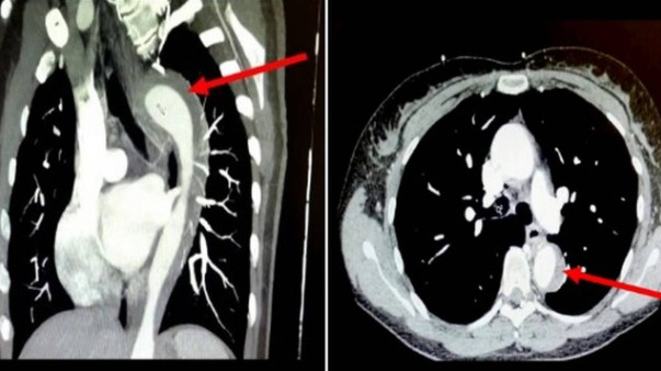 Mulher sofre vazamento na aorta durante orgasmo, em caso médico incomum