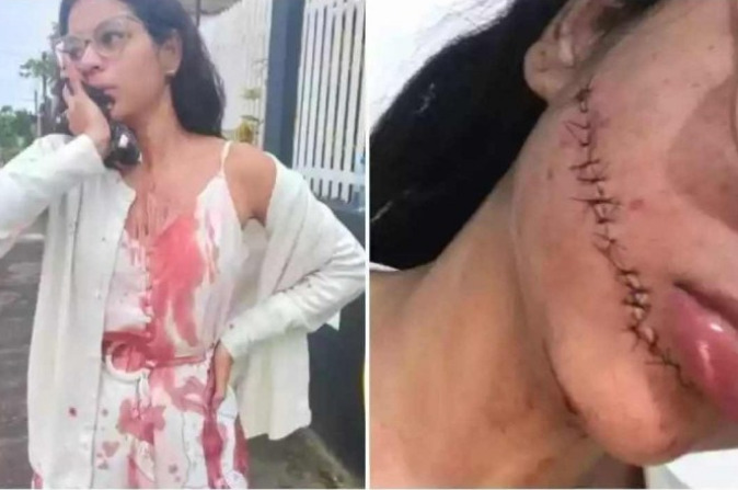 Jovem tem rosto cortado na Bahia enquanto dormia em viagem de ônibus