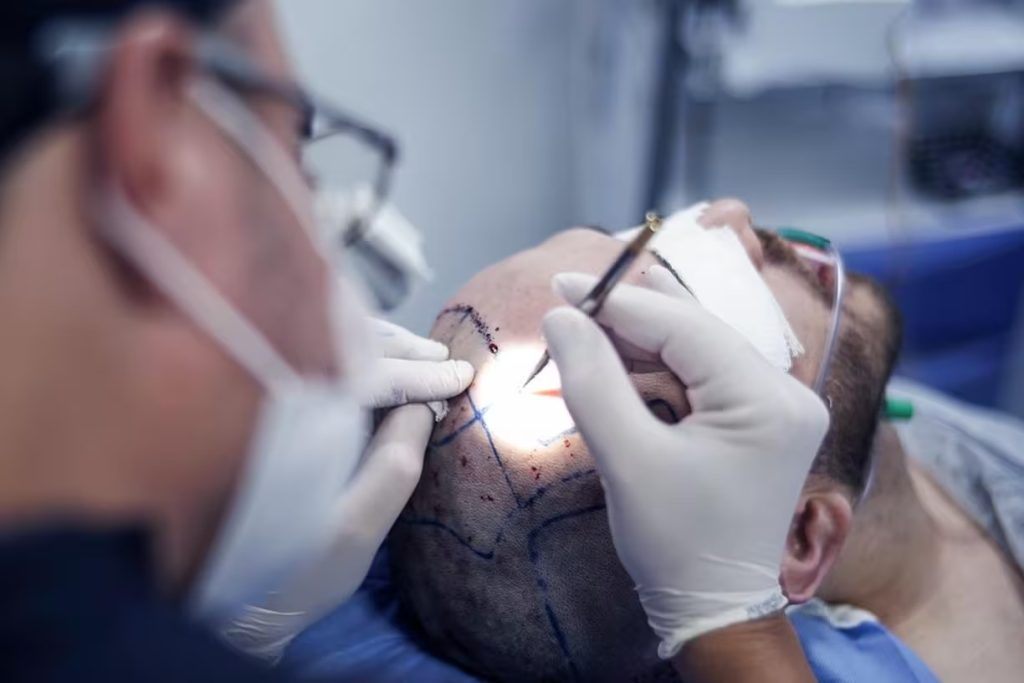 Primeiro hospital do mundo para transplante capilar será inaugurado em SP