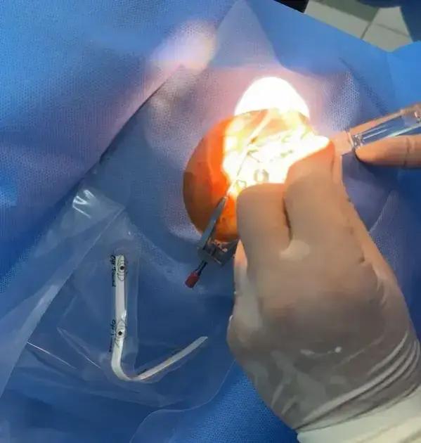 Timóteo promove mutirão com mais de 300 cirurgias de catarata